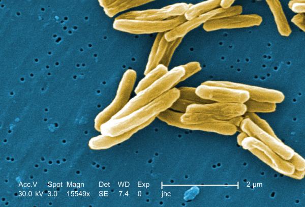 Indian American Stanford scientist’s findings could diagnose active tuberculosis